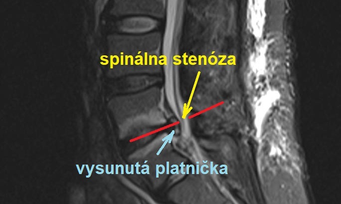 vysunuta platnicka
